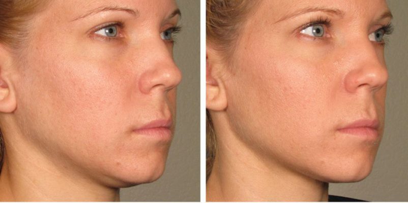 Skin Tightening & Face Lifting