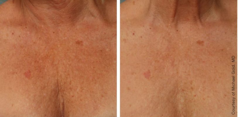 Best Laser Skin Treatment Clinic for Men and Women