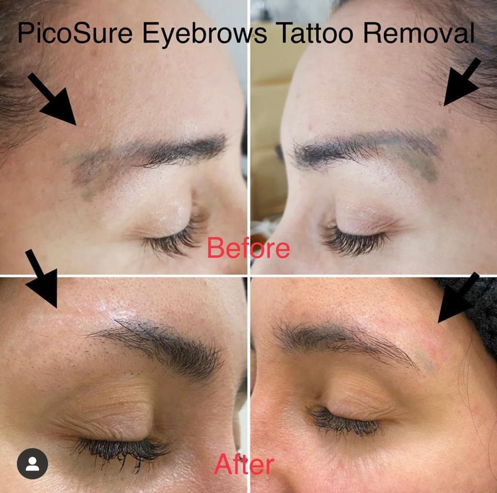 Eyebrow Tattoo Removal | Sydney Lash & Brow in Bondi Junction