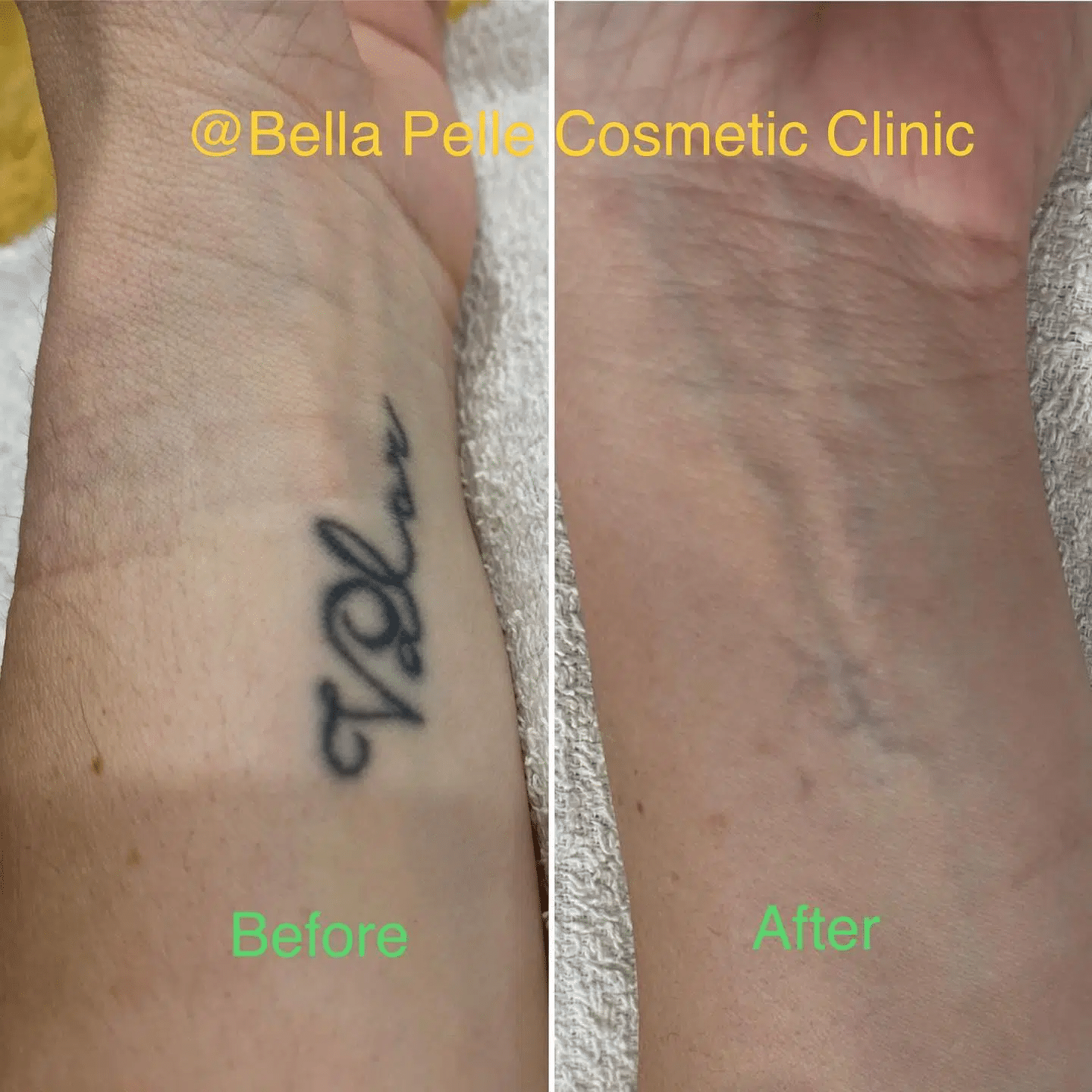 Laser Tattoo Removal - La Fameux Derma
