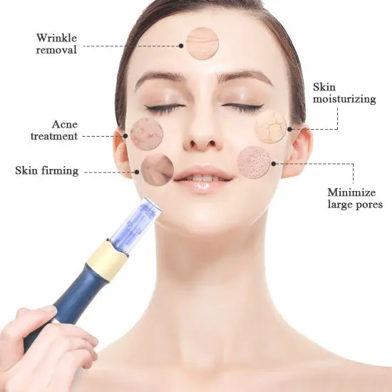 Micro Needling Treatment Sydney Bella Pelle Cosmetic Clinic